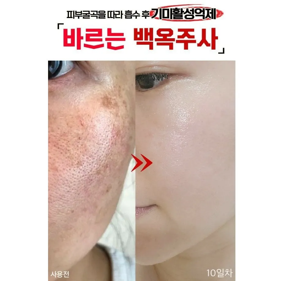 Made in Korea Glutathione Essence Cica Fluid melasma-x Skin soothing moisturizing essence that melts the freckles (1 1 1)(free shipping)